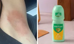 Hudirritation efter användning av Mitchum deo dam. En grön roll-on deodorant syns bredvid.