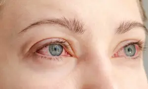Närbild på ögon med rodnad runt ögonlocken, ett av symtomen vid rosacea.
