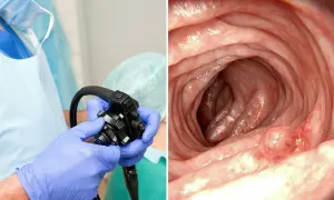Läkare förbereder koloskopi. Bilden visar insidan av tarmen med en polyp, vilket kan vara en av de potentiella askorbinsyra biverkningar vid överdosering.