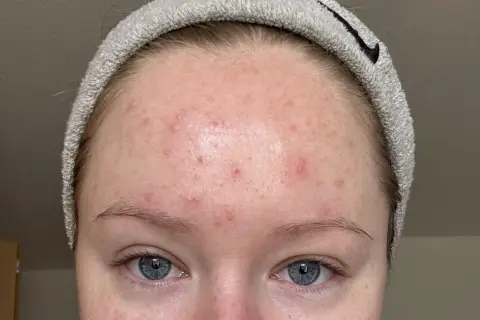 Närbild på en panna med rodnad och små utslag, misstänkt fungal acne.