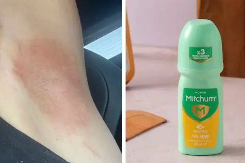 Hudirritation efter användning av Mitchum deo dam. En grön roll-on deodorant syns bredvid.