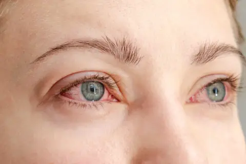 Närbild på ögon med rodnad runt ögonlocken, ett av symtomen vid rosacea.