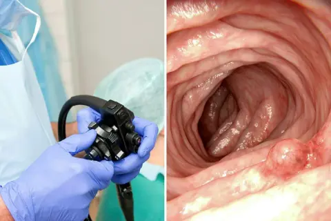 Läkare förbereder koloskopi. Bilden visar insidan av tarmen med en polyp, vilket kan vara en av de potentiella askorbinsyra biverkningar vid överdosering.
