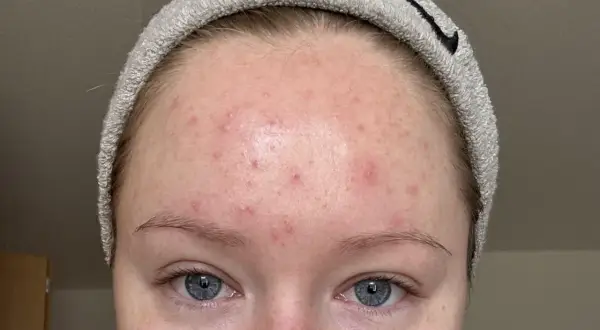 Närbild på en panna med rodnad och små utslag, misstänkt fungal acne.