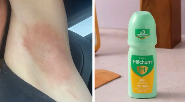 Hudirritation efter användning av Mitchum deo dam. En grön roll-on deodorant syns bredvid.