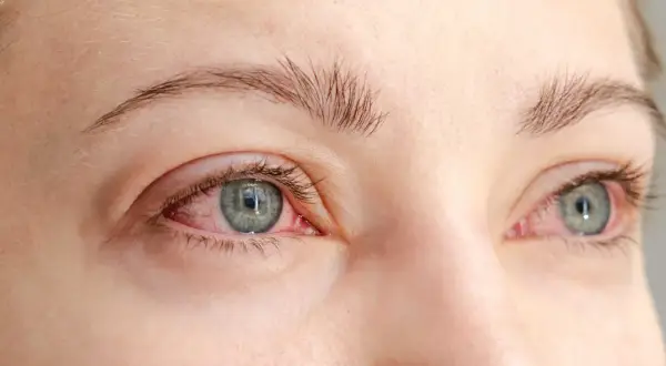 Närbild på ögon med rodnad runt ögonlocken, ett av symtomen vid rosacea.