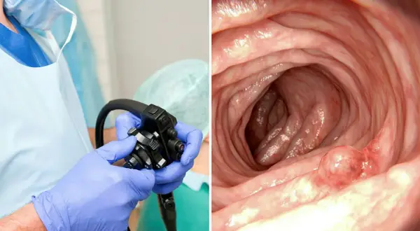 Läkare förbereder koloskopi. Bilden visar insidan av tarmen med en polyp, vilket kan vara en av de potentiella askorbinsyra biverkningar vid överdosering.