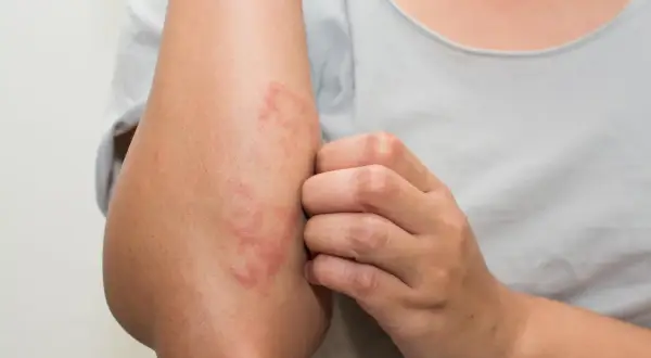 En arm med utslag och mycket torr hud. En hand kliar på utslaget.