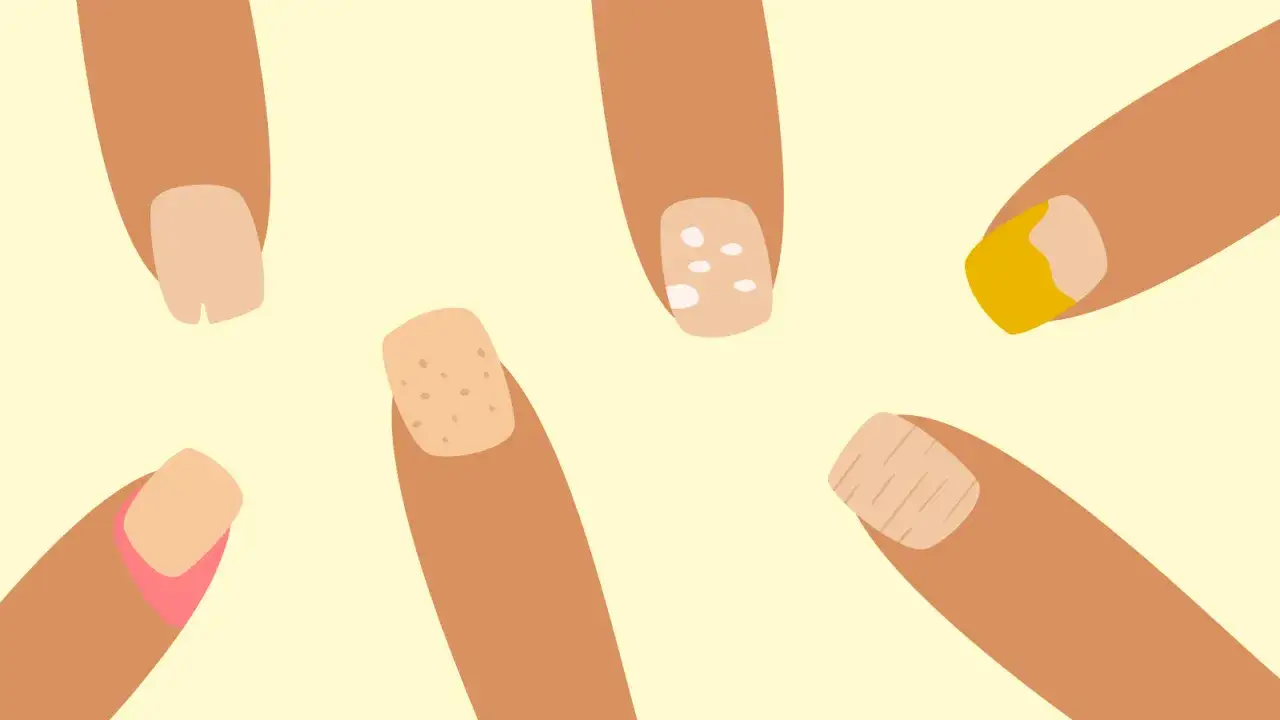 Illustration av fingrar med olika naglar, vissa med fl&auml;ckar eller linjer som kan tyda p&aring; vita naglar sjukdom.