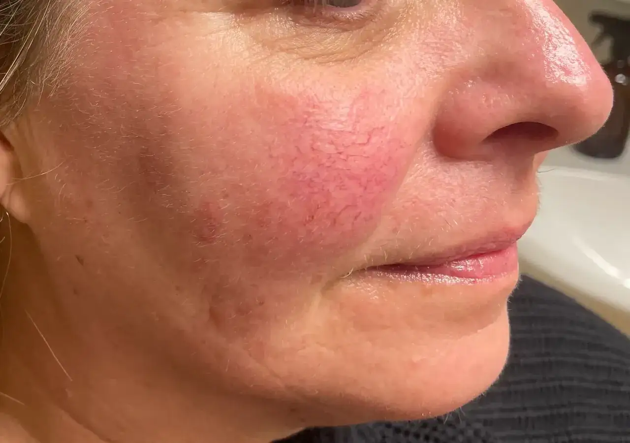 Närbild på en kvinnas kind med synliga blodkärl och rodnad, tydliga rosacea symtom.