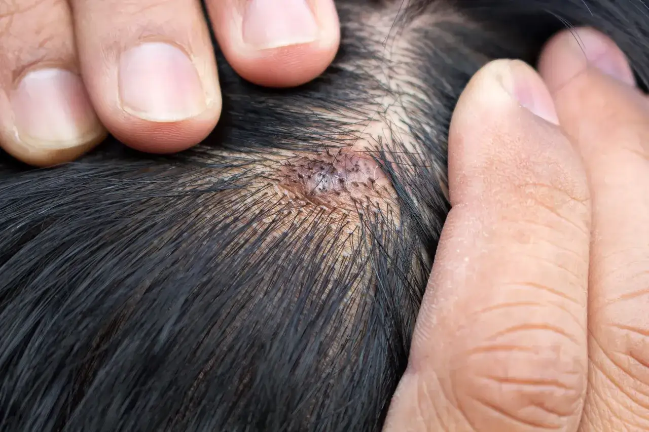 Närbild på en irriterad hårbotten med en skada som behöver z skin repair. Fingrar håller undan mörkt hår för att visa området.
