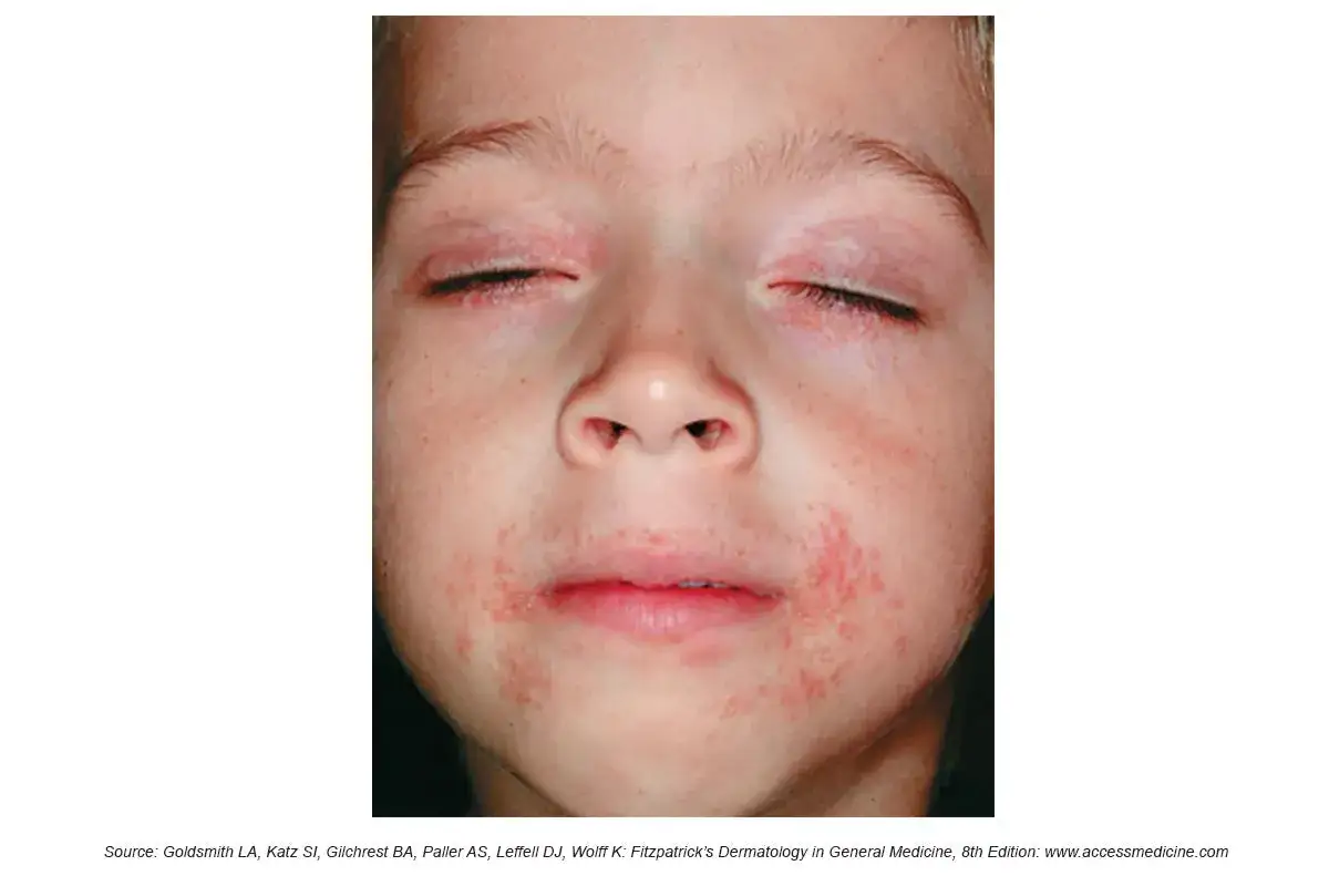 Barn med rodnad och utslag runt munnen, tecken på perioral dermatit. Ögonlocken är också irriterade.