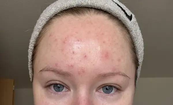 Närbild på en panna med rodnad och små utslag, misstänkt fungal acne.