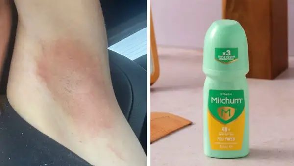 Hudirritation efter användning av Mitchum deo dam. En grön roll-on deodorant syns bredvid.