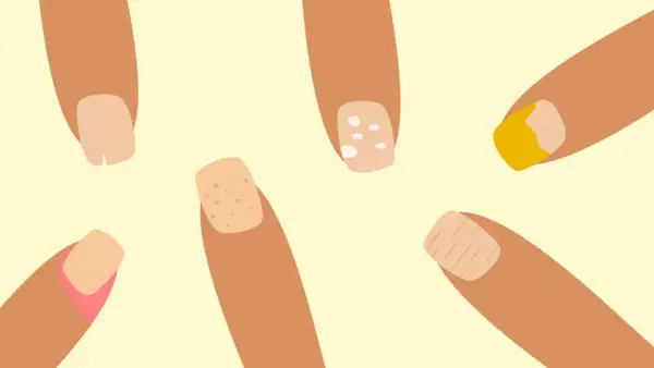 Illustration av fingrar med olika naglar. En nagel har vita prickar, en annan ser ut att ha en sjukdom.