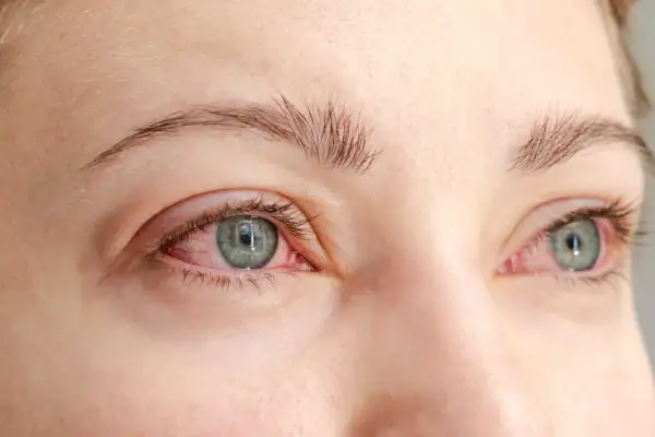 Närbild på ögon med rodnad runt ögonlocken, ett av symtomen vid rosacea.